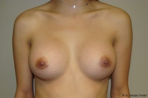 Breast Augmentation Before and After | Grover Aesthetics