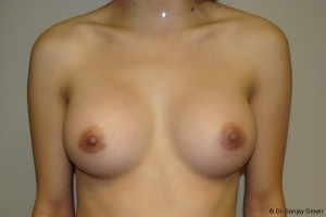 Breast Augmentation Before and After | Sanjay Grover MD FACS