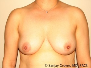 Breast Augmentation Before and After 143 | Sanjay Grover MD FACS