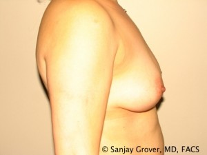 Breast Augmentation Before and After 68 | Sanjay Grover MD FACS