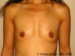 Breast Augmentation Before and After 136 | Sanjay Grover MD FACS