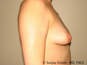 Breast Augmentation Before and After 72 | Sanjay Grover MD FACS