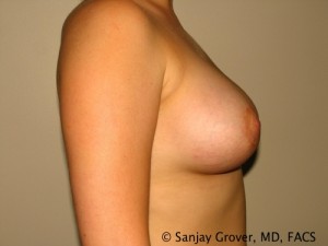 Breast Augmentation Before and After 72 | Grover Aesthetics