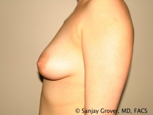 Breast Augmentation Before and After 72 | Grover Aesthetics
