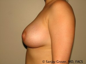 Breast Augmentation Before and After 72 | Grover Aesthetics