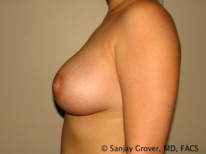 Breast Augmentation Before and After 72 | Sanjay Grover MD FACS