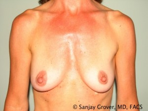 Breast Augmentation Before and After 53 | Sanjay Grover MD FACS