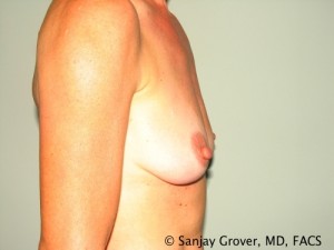 Breast Augmentation Before and After 73 | Grover Aesthetics