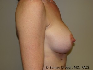 Breast Augmentation Before and After 73 | Grover Aesthetics