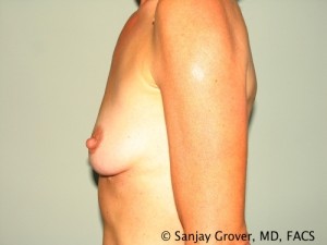 Breast Augmentation Before and After 73 | Grover Aesthetics