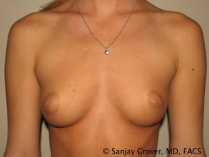 Breast Augmentation Before and After | Grover Aesthetics