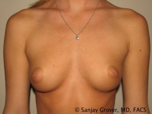 Breast Augmentation Before and After | Sanjay Grover MD FACS