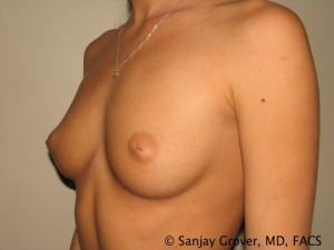 Breast Augmentation Before and After 74 | Grover Aesthetics