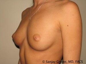 Breast Augmentation Before and After 74 | Sanjay Grover MD FACS