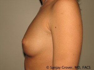 Breast Augmentation Before and After 74 | Grover Aesthetics