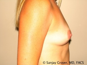 Breast Augmentation Before and After 75 | Sanjay Grover MD FACS