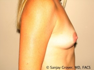 Breast Augmentation Before and After 76 | Grover Aesthetics