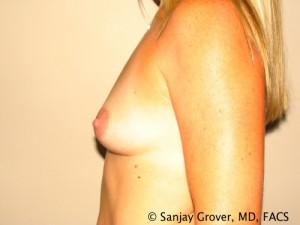 Breast Augmentation Before and After 76 | Grover Aesthetics
