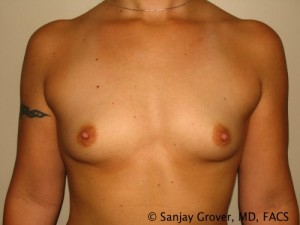 Breast Augmentation Before and After | Grover Aesthetics