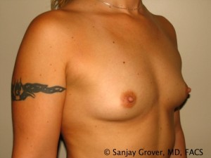 Breast Augmentation Before and After 77 | Grover Aesthetics