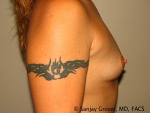 Breast Augmentation Before and After 77 | Grover Aesthetics