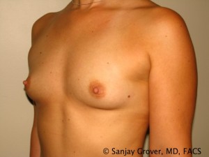 Breast Augmentation Before and After 77 | Grover Aesthetics