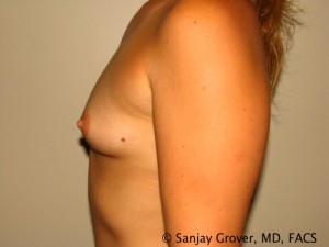 Breast Augmentation Before and After 77 | Grover Aesthetics