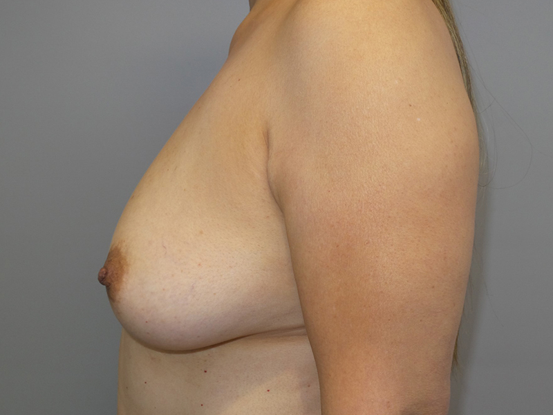 Breast Augmentation Before and After 78 | Grover Aesthetics