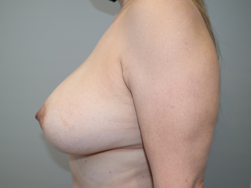 Breast Augmentation Before and After 78 | Grover Aesthetics