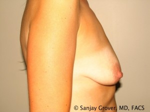 Breast Augmentation Before and After 79 | Grover Aesthetics