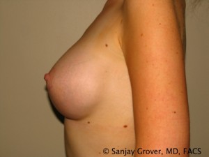Breast Augmentation Before and After 80 | Grover Aesthetics