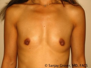 Breast Augmentation Before and After | Grover Aesthetics
