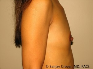 Breast Augmentation Before and After 81 | Grover Aesthetics