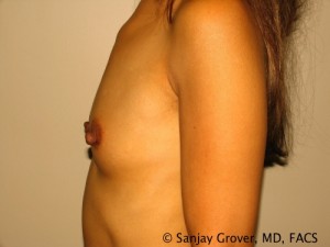 Breast Augmentation Before and After 81 | Grover Aesthetics