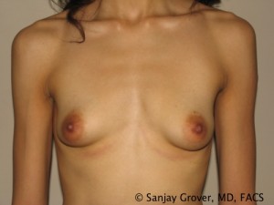 Breast Augmentation Before and After | Sanjay Grover MD FACS