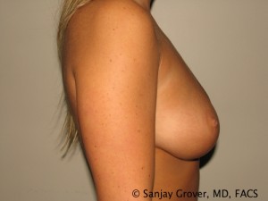 Breast Augmentation Before and After 83 | Grover Aesthetics