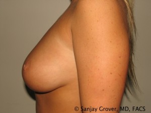 Breast Augmentation Before and After 83 | Grover Aesthetics