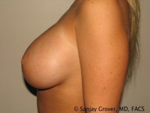 Breast Augmentation Before and After 83 | Grover Aesthetics