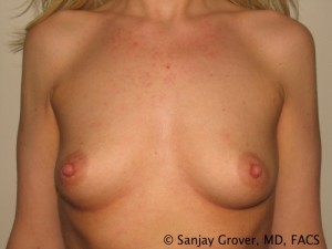 Breast Augmentation Before and After 138 | Sanjay Grover MD FACS