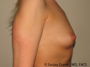 Breast Augmentation Before and After 84 | Grover Aesthetics