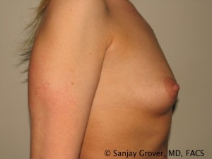 Breast Augmentation Before and After 84 | Sanjay Grover MD FACS