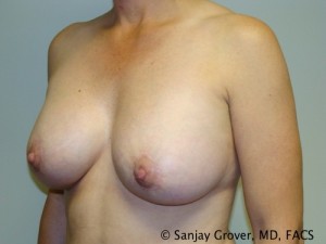 Breast Augmentation Before and After 84 | Sanjay Grover MD FACS