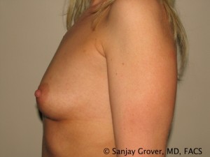 Breast Augmentation Before and After 84 | Grover Aesthetics
