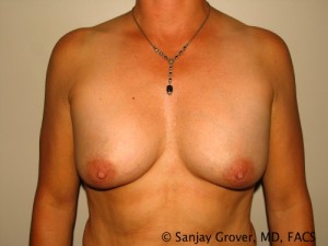 Breast Augmentation Before and After | Grover Aesthetics