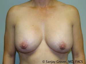 Breast Augmentation Before and After 85 | Sanjay Grover MD FACS