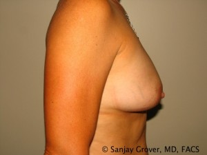 Breast Augmentation Before and After 85 | Grover Aesthetics