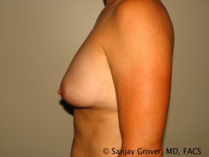 Breast Augmentation Before and After 85 | Grover Aesthetics