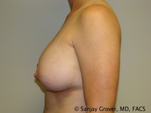 Breast Augmentation Before and After 85 | Grover Aesthetics