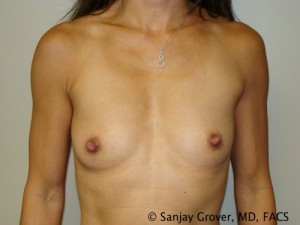 Breast Augmentation Before and After | Grover Aesthetics