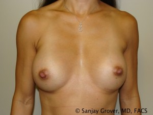 Breast Augmentation Before and After | Grover Aesthetics
